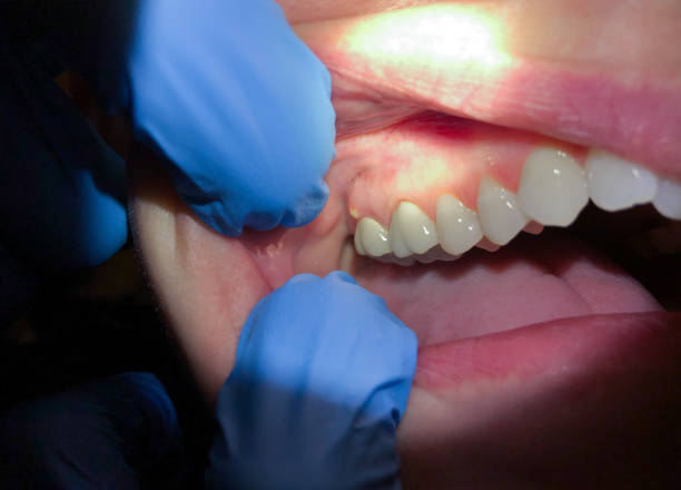 Best Emergency Care for Gum Disease in South Hempstead, NY